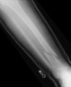 Orthopedic Fracture Care and Repair - Orthopedic Specialists of Seattle