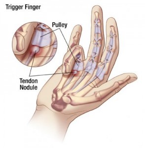 Trigger Finger: Causes, Symptoms, Treatment and Exercises