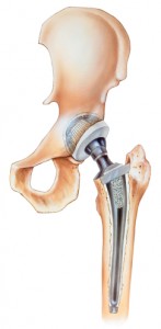 Anterior Hip Replacement - Orthopedic Specialists of Seattle