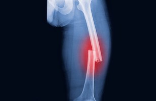 Fractured Bone in X-Ray Imaging