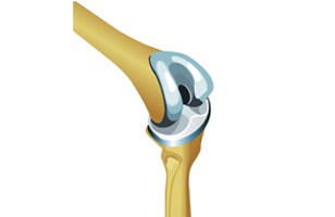 Partial Joint Replacement