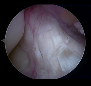 Arthroscopic view of the normal ACL
