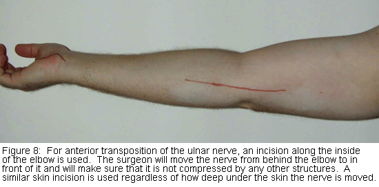 Ulnar Nerve Entrapment, Elbow Specialist