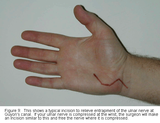 Ulnar nerve release