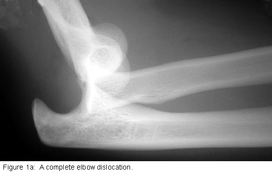 Complete Elbow Dislocation