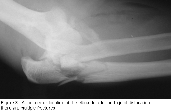 Fractures and Complex Dislocation of Elbow