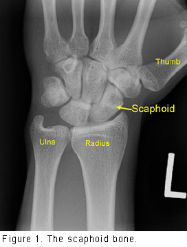 scaphoid fracture cast