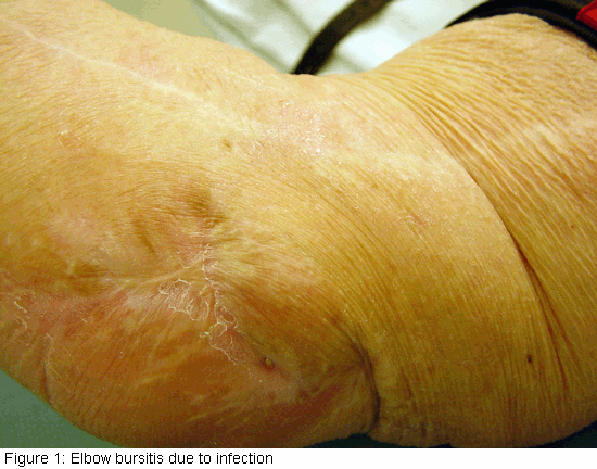 infected olecranon bursitis