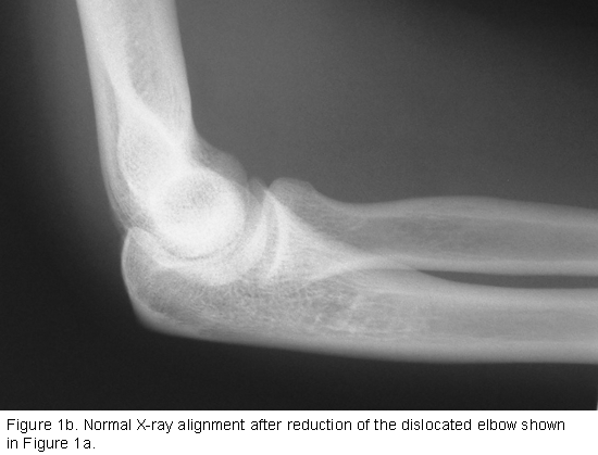 After Reduction of the Dislocated Elbow