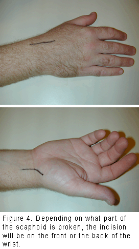 Túlerőltetés és gyulladás is okozhat alkarfájdalmat - Fájdalom a bal kéz ízületében hajlításkor