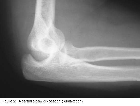 Partial Elbow Dislocation