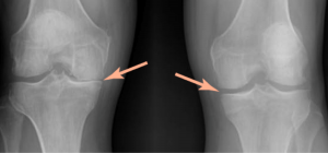 kneearthritis2-300x140