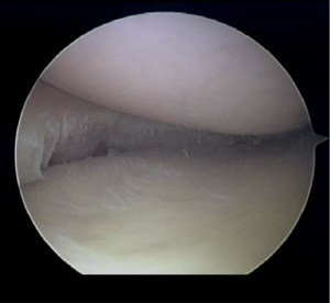 meniscus4-300x276