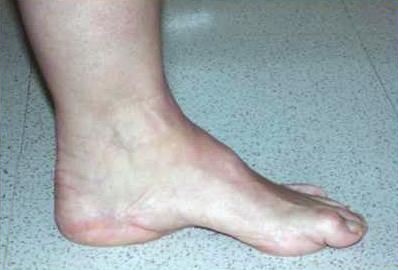 patient with cavus foot