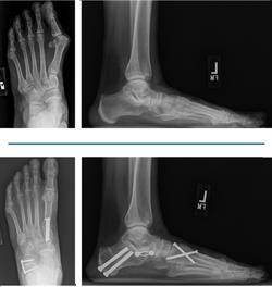 X ray views of a flatfoot before and after