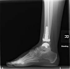 Post-surgery x-ray of a total ankle replacement