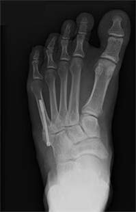 Screw fixation of a fifth metatarsal base fracture